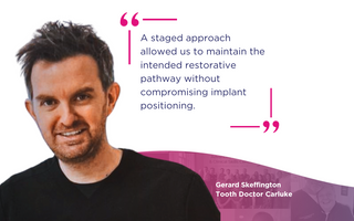 Staged Implant Placement in Dual Arch Rehabilitation: A Case Study by Dr Gerry Skeffington
