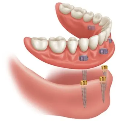 OVERDENTURE ON LOCATORS - LAB FIT/D/NED