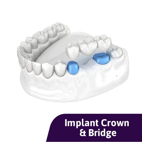 Porcelain Fused Zirconia Implant Bridge (PFZ-I)