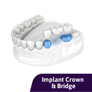 Monolithic Zirconia Implant Bridge (TLZ-I)