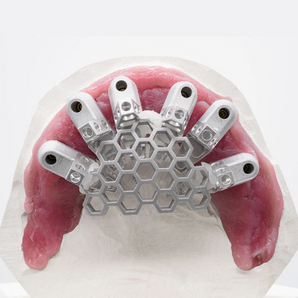 Grammetry OptiSplint Single-Arch Pack