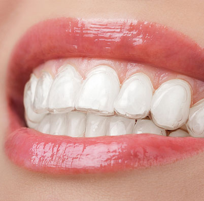 Whitening Tray